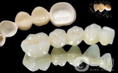 貴金屬烤瓷牙有哪些種類？