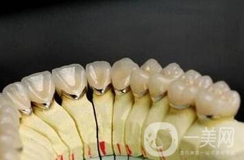 貴金屬烤瓷牙有哪些種類？