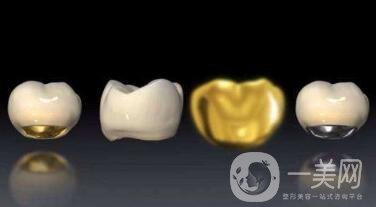 貴金屬烤瓷牙有哪些種類？