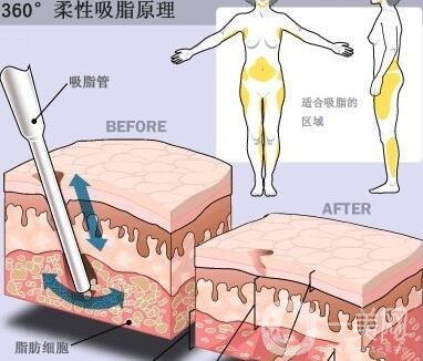 360度吸脂減肥貴嗎?*果如何?