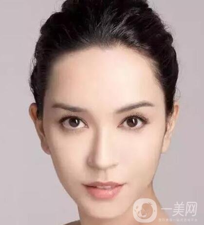 取出隆鼻假體*嗎?需要多少錢?