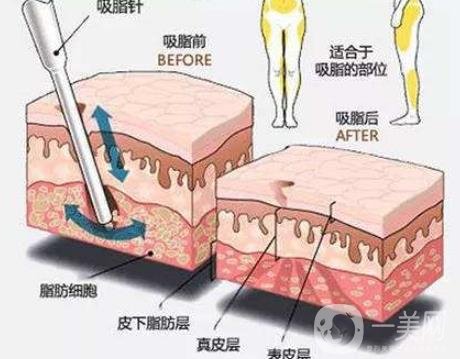 全身抽脂減肥價(jià)格大概要多少錢？