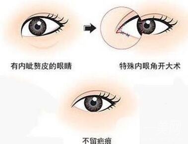 開眼角手術過程中疼嗎?要多久?