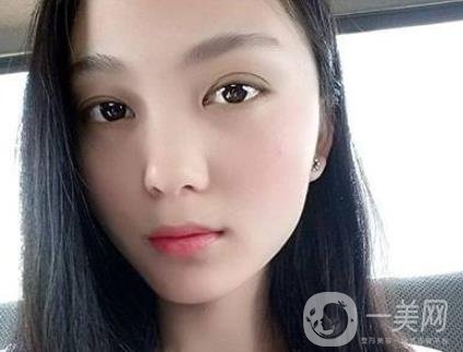 吸雕雙眼皮手術(shù)是什么？是埋線嗎？