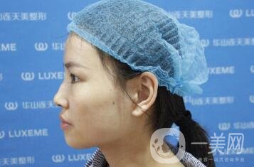 伊凡露注射隆鼻