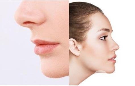 怎樣讓鼻子變高？隆鼻可以讓鼻子變高嗎？