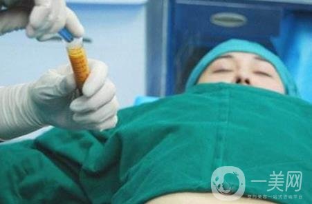 全身抽脂手術(shù)要多久？要花多少錢？