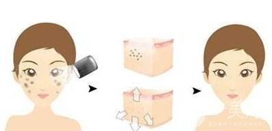 光子嫩膚的原理是什么？*果怎樣？