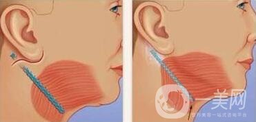 頸部除皺提升術(shù)要多少錢(qián)？貴不貴？