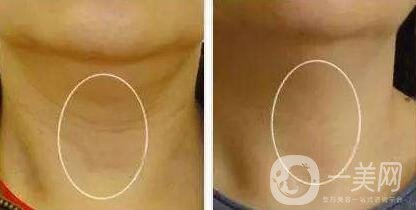 頸部除皺提升術(shù)要多少錢(qián)？貴不貴？