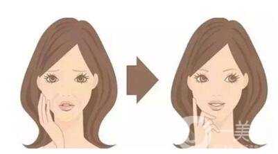 頸部除皺提升術(shù)要多少錢(qián)？貴不貴？