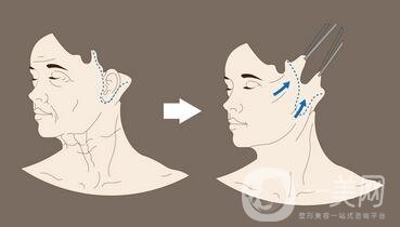 頸部除皺提升術(shù)要多少錢(qián)？貴不貴？