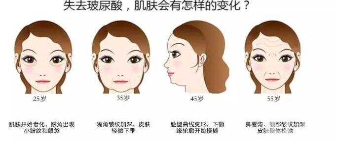 【至小白篇】玻尿酸有幾種品牌和類型?