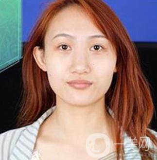 長沙微恩醫(yī)療整形醫(yī)院 隆鼻