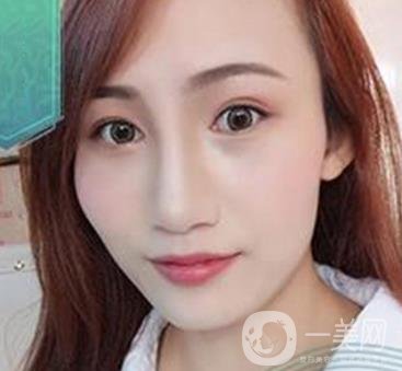 長沙微恩醫(yī)療整形醫(yī)院 隆鼻