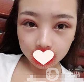 西南醫(yī)院整形美容外科雙眼皮