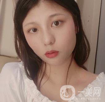 六盤水友好整形醫(yī)院雙眼皮