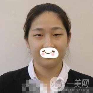 濟(jì)南旭美整形醫(yī)院靠譜嗎?附雙眼皮案例和全新價(jià)格表