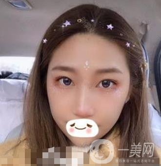 濟(jì)南旭美整形醫(yī)院靠譜嗎?附雙眼皮案例和全新價(jià)格表