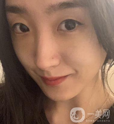 吉大一院整形外科價(jià)格表明細(xì)公布，隆鼻紀(jì)實(shí)案例分享