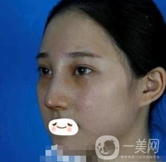 廣州禾麗醫(yī)院做雙眼皮怎么樣?看*果圖和價(jià)格表