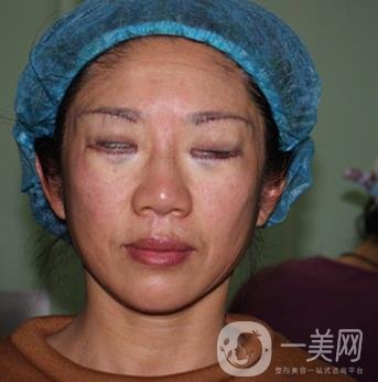 安徽醫(yī)科大學(xué)第(一)附屬醫(yī)院整形外科價(jià)格表，附去眼袋案例