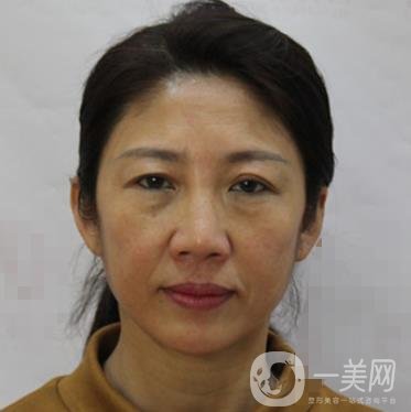 安徽醫(yī)科大學(xué)第(一)附屬醫(yī)院整形外科價(jià)格表，附去眼袋案例