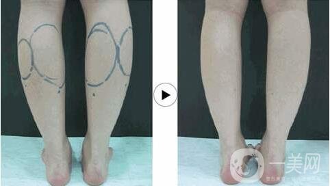 小腿吸脂后多久才能變細(xì)?