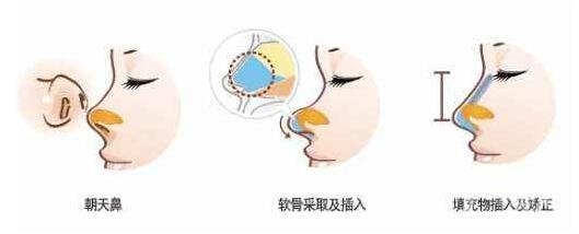 朝天鼻整形可以不放假體嗎?