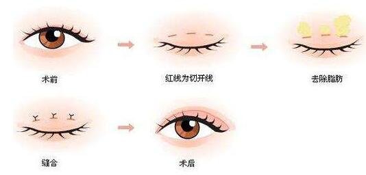 三點雙眼皮能維持幾年?