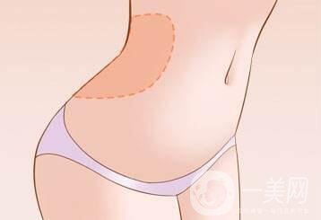 腰腹吸脂多久消腫?多久看到*果?