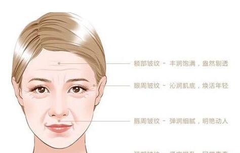 須知_嗨體祛除頸紋的常見的4個問題