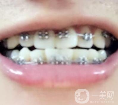 濰坊市人民醫(yī)院 整牙齒