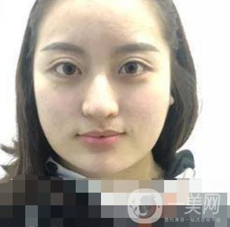 河北省人民醫(yī)院整形外科價格表新版來襲，附去下頜骨案例