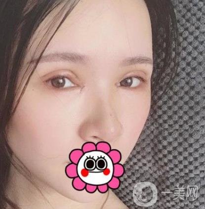 金華中心醫(yī)院整形美容科價格表+割雙眼皮案例一覽