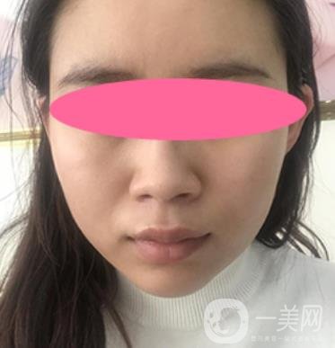 寧波第一醫(yī)院整形科價(jià)格表收費(fèi)明細(xì)上線，看打玻尿酸真人案例