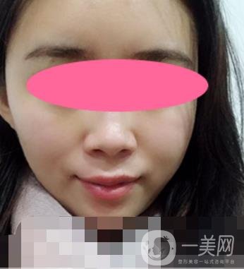 寧波第一醫(yī)院整形科價(jià)格表收費(fèi)明細(xì)上線，看打玻尿酸真人案例