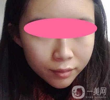 寧波第一醫(yī)院整形科價(jià)格表收費(fèi)明細(xì)上線，看打玻尿酸真人案例