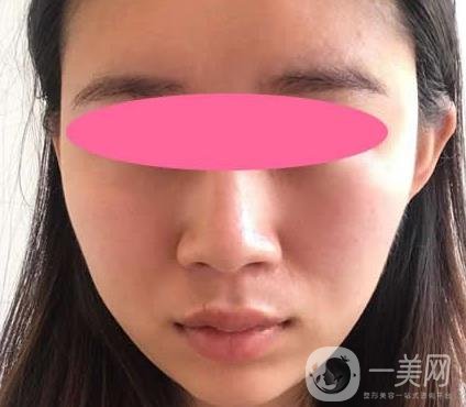 寧波第一醫(yī)院整形科價(jià)格表收費(fèi)明細(xì)上線，看打玻尿酸真人案例