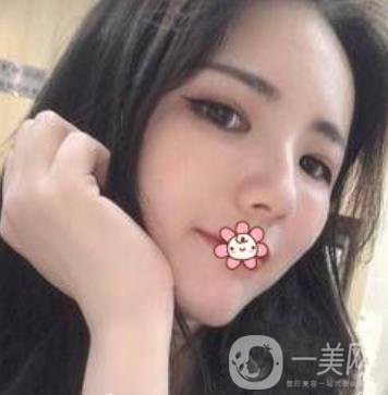 上海第九人民醫(yī)院整形外科價格表，附面部脂肪填充案例