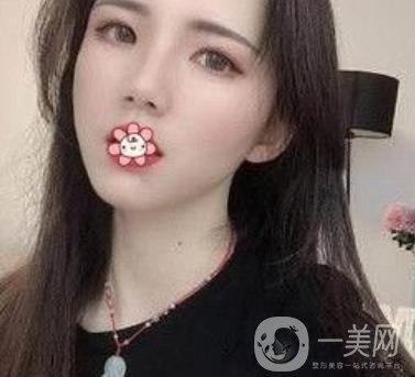 上海第九人民醫(yī)院整形外科價格表，附面部脂肪填充案例