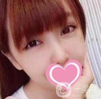 上海第一醫(yī)院整形外科價(jià)格表明細(xì)及割雙眼皮日記分享