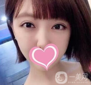 上海第一醫(yī)院整形外科價(jià)格表明細(xì)及割雙眼皮日記分享