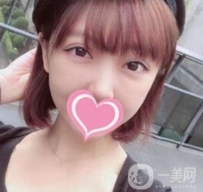 上海第一醫(yī)院整形外科價(jià)格表明細(xì)及割雙眼皮日記分享