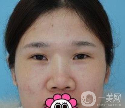 2020北京大學(xué)深圳醫(yī)院整形科價格表，附雙眼皮案例