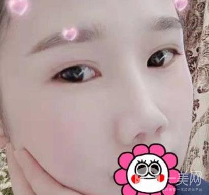 2020北京大學(xué)深圳醫(yī)院整形科價格表，附雙眼皮案例