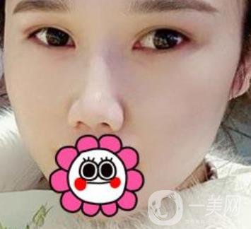 2020北京大學(xué)深圳醫(yī)院整形科價格表，附雙眼皮案例