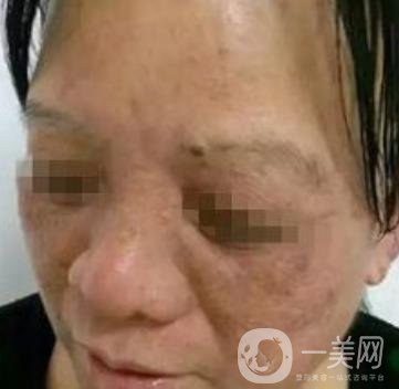 廣東省人民醫(yī)院整形科價格表，附祛斑整形日記