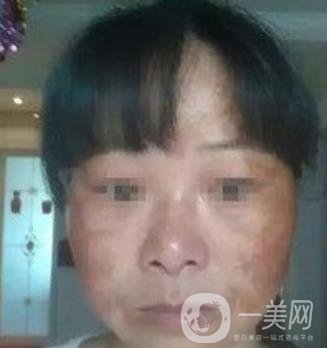 廣東省人民醫(yī)院整形科價格表，附祛斑整形日記