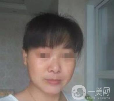 廣東省人民醫(yī)院整形科價格表，附祛斑整形日記